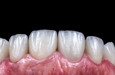 ceramic-veneer-panmure-auckland