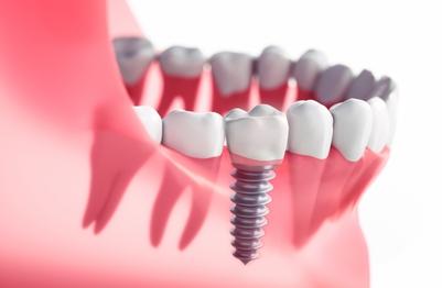 dental-implant-panmure-auckland