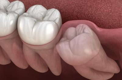 wisdom-teeth-panmure-auckland